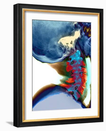 Arthritis In Neck, X-ray-Du Cane Medical-Framed Photographic Print