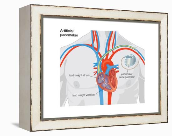 Artificial Pacemaker-Encyclopaedia Britannica-Framed Stretched Canvas