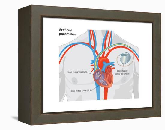 Artificial Pacemaker-Encyclopaedia Britannica-Framed Stretched Canvas