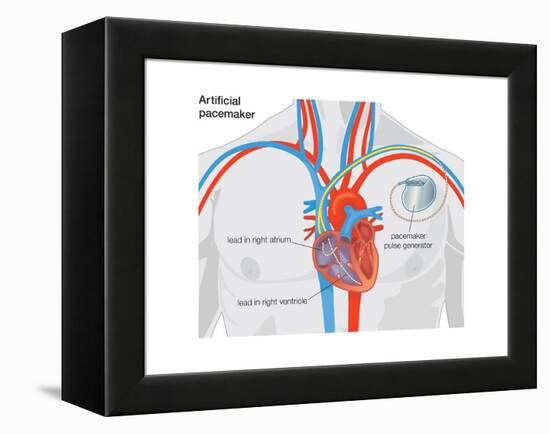 Artificial Pacemaker-Encyclopaedia Britannica-Framed Stretched Canvas