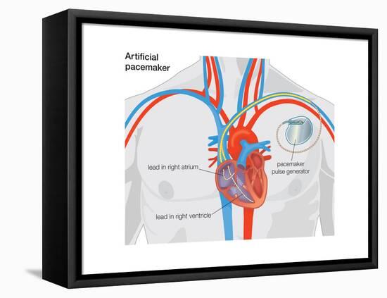 Artificial Pacemaker-Encyclopaedia Britannica-Framed Stretched Canvas