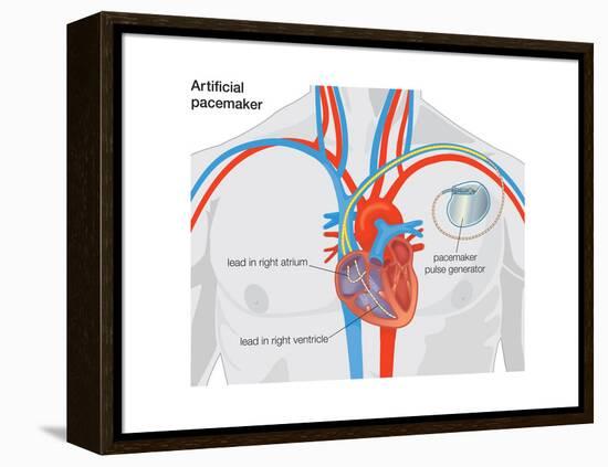 Artificial Pacemaker-Encyclopaedia Britannica-Framed Stretched Canvas