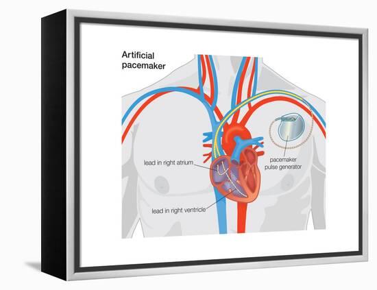 Artificial Pacemaker-Encyclopaedia Britannica-Framed Stretched Canvas