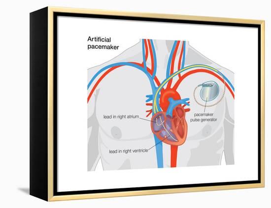 Artificial Pacemaker-Encyclopaedia Britannica-Framed Stretched Canvas