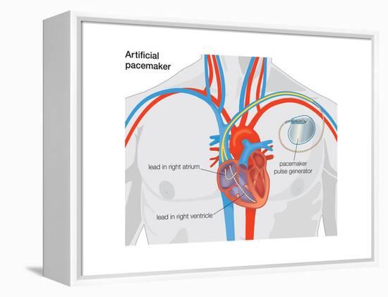 Artificial Pacemaker-Encyclopaedia Britannica-Framed Stretched Canvas