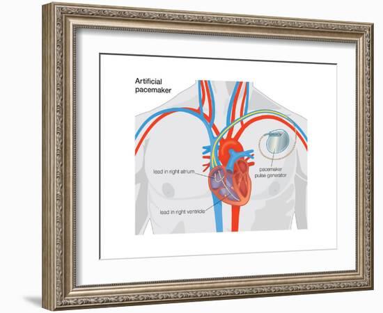 Artificial Pacemaker-Encyclopaedia Britannica-Framed Art Print