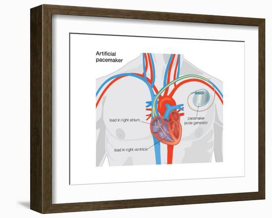 Artificial Pacemaker-Encyclopaedia Britannica-Framed Art Print