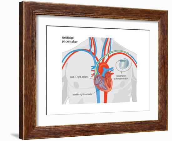 Artificial Pacemaker-Encyclopaedia Britannica-Framed Art Print