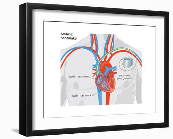 Artificial Pacemaker-Encyclopaedia Britannica-Framed Art Print