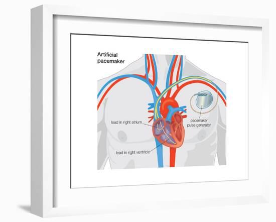 Artificial Pacemaker-Encyclopaedia Britannica-Framed Art Print