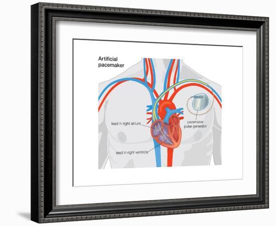 Artificial Pacemaker-Encyclopaedia Britannica-Framed Art Print