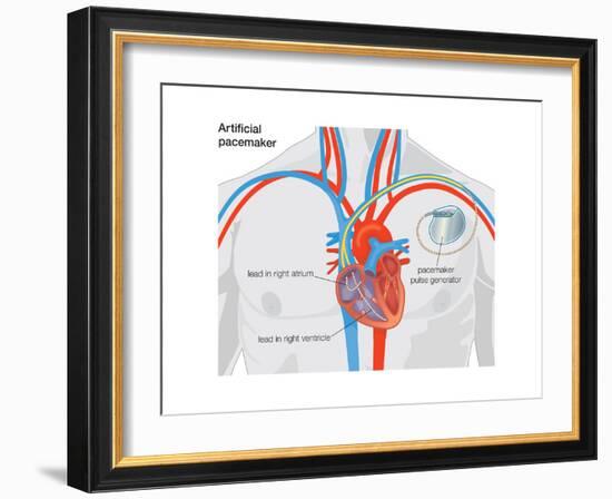 Artificial Pacemaker-Encyclopaedia Britannica-Framed Art Print