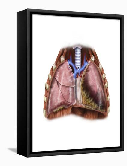 Artist Depiction of Mesothelioma in the Lungs-Abdominal Cavity-null-Framed Stretched Canvas