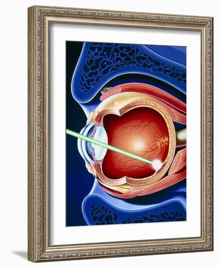 Artwork of Laser Surgery on Detached Retina-John Bavosi-Framed Photographic Print