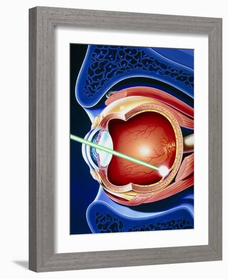 Artwork of Laser Surgery on Detached Retina-John Bavosi-Framed Photographic Print