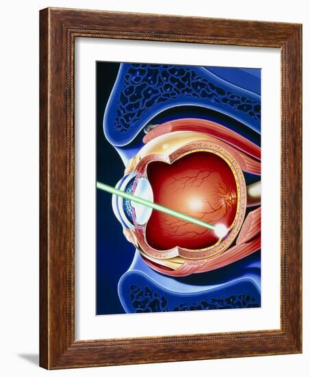 Artwork of Laser Surgery on Detached Retina-John Bavosi-Framed Photographic Print