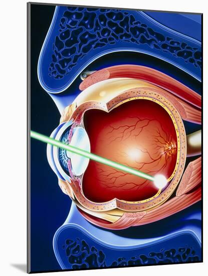 Artwork of Laser Surgery on Detached Retina-John Bavosi-Mounted Photographic Print