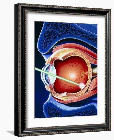 Artwork of Laser Surgery on Detached Retina-John Bavosi-Framed Photographic Print