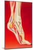 Artwork Showing Calcaneal Spur And Foot Pain-John Bavosi-Mounted Photographic Print