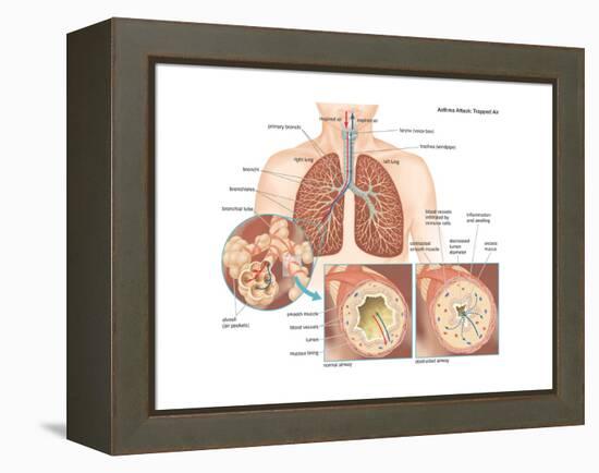 Asthma Attack-Encyclopaedia Britannica-Framed Stretched Canvas