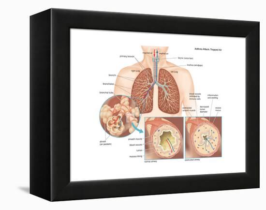 Asthma Attack-Encyclopaedia Britannica-Framed Stretched Canvas