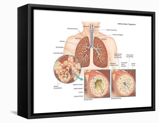 Asthma Attack-Encyclopaedia Britannica-Framed Stretched Canvas