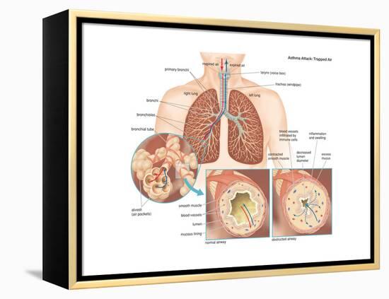 Asthma Attack-Encyclopaedia Britannica-Framed Stretched Canvas