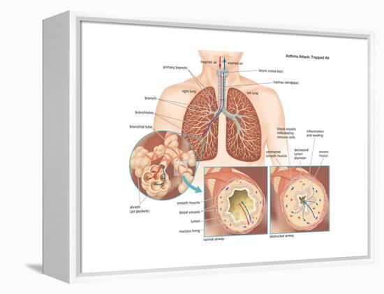 Asthma Attack-Encyclopaedia Britannica-Framed Stretched Canvas