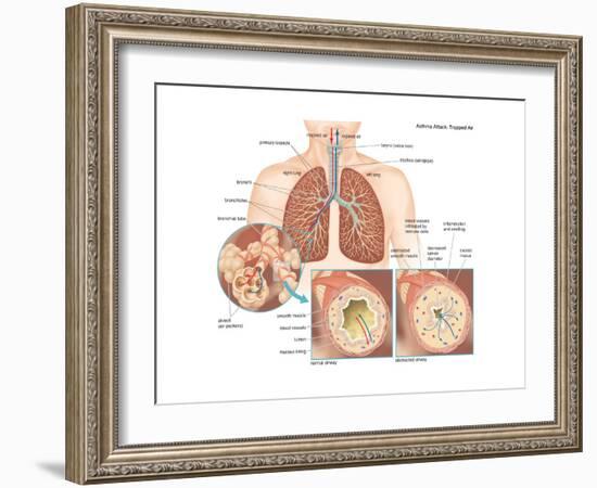 Asthma Attack-Encyclopaedia Britannica-Framed Art Print