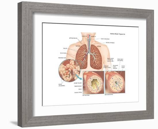 Asthma Attack-Encyclopaedia Britannica-Framed Art Print