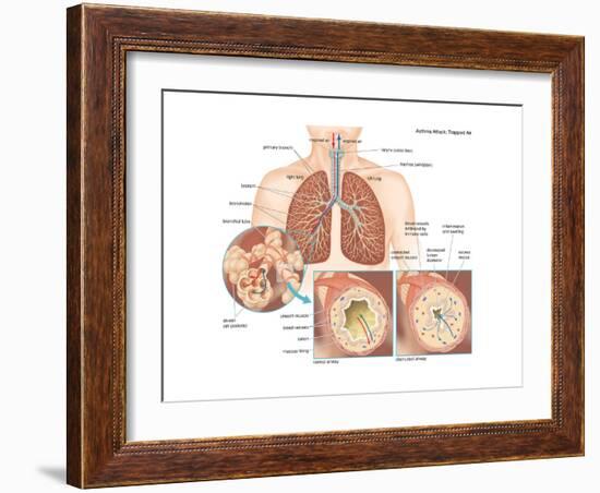 Asthma Attack-Encyclopaedia Britannica-Framed Art Print