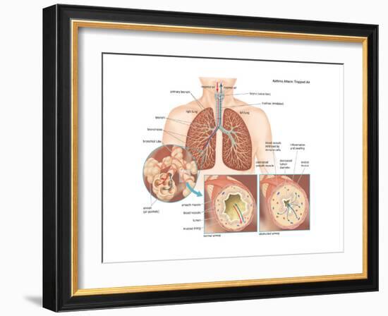 Asthma Attack-Encyclopaedia Britannica-Framed Art Print