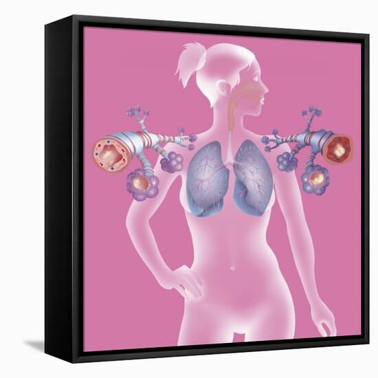 Asthma, Drawing-Caroline Arquevaux-Framed Premier Image Canvas