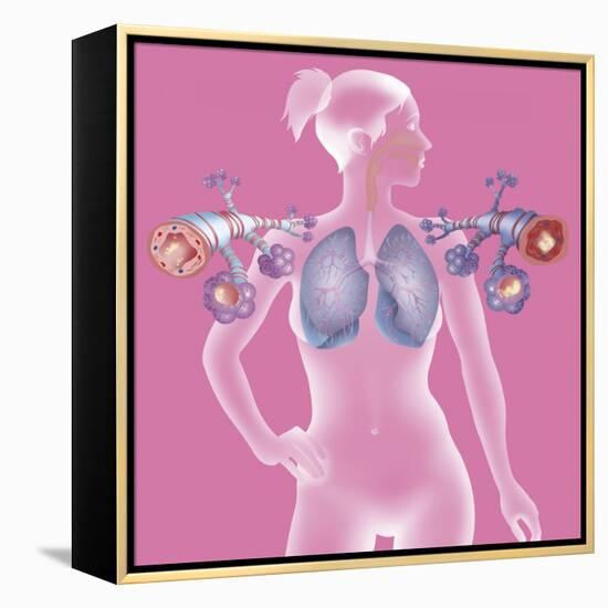 Asthma, Drawing-Caroline Arquevaux-Framed Premier Image Canvas