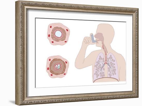 Asthma Pathology And Treatment, Diagram-Peter Gardiner-Framed Photographic Print