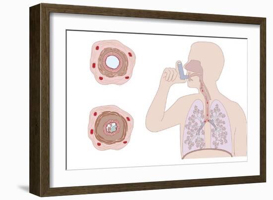 Asthma Pathology And Treatment, Diagram-Peter Gardiner-Framed Photographic Print