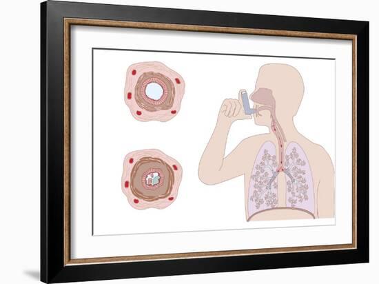 Asthma Pathology And Treatment, Diagram-Peter Gardiner-Framed Photographic Print