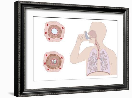 Asthma Pathology And Treatment, Diagram-Peter Gardiner-Framed Photographic Print