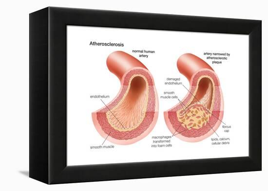Atherosclerosis-Encyclopaedia Britannica-Framed Stretched Canvas