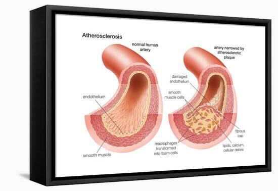 Atherosclerosis-Encyclopaedia Britannica-Framed Stretched Canvas