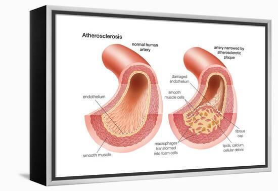 Atherosclerosis-Encyclopaedia Britannica-Framed Stretched Canvas