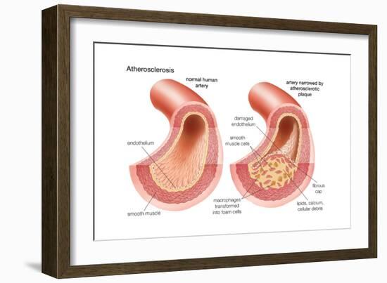 Atherosclerosis-Encyclopaedia Britannica-Framed Art Print