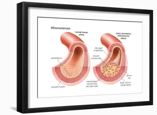 Atherosclerosis-Encyclopaedia Britannica-Framed Art Print