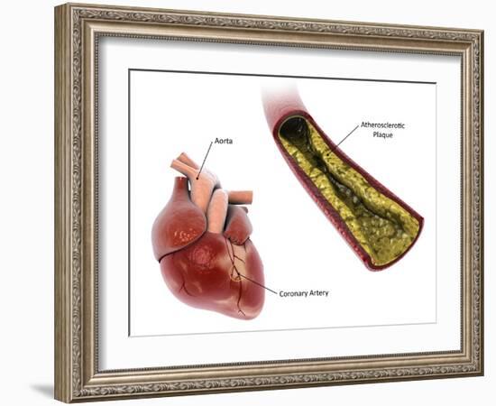 Atherosclerotic plaque in the artery, leading to a heart attack.-Stocktrek Images-Framed Art Print