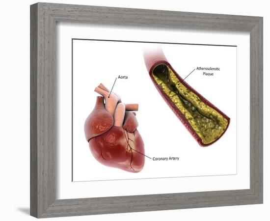 Atherosclerotic plaque in the artery, leading to a heart attack.-Stocktrek Images-Framed Art Print