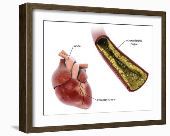 Atherosclerotic plaque in the artery, leading to a heart attack.-Stocktrek Images-Framed Art Print