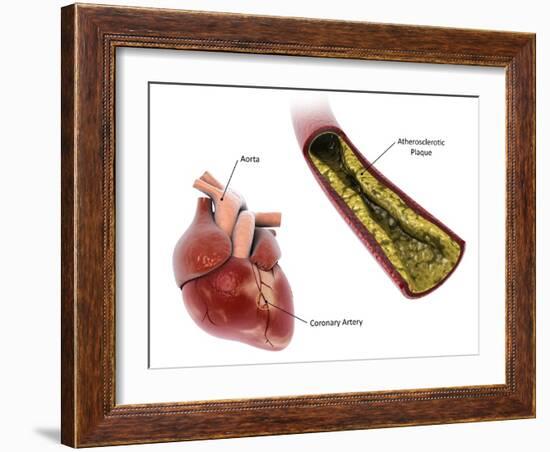 Atherosclerotic plaque in the artery, leading to a heart attack.-Stocktrek Images-Framed Art Print