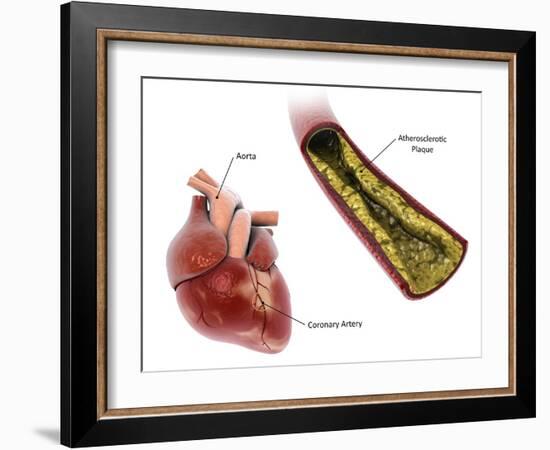 Atherosclerotic plaque in the artery, leading to a heart attack.-Stocktrek Images-Framed Art Print