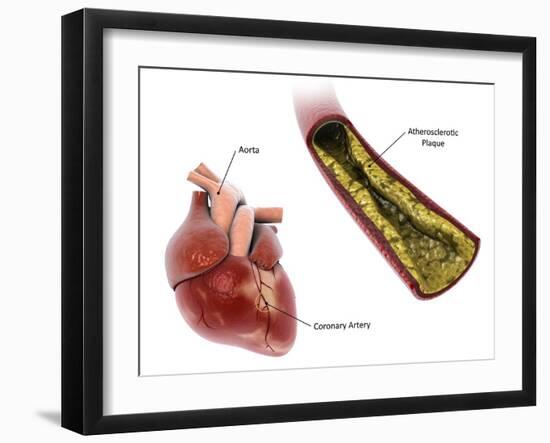 Atherosclerotic plaque in the artery, leading to a heart attack.-Stocktrek Images-Framed Art Print