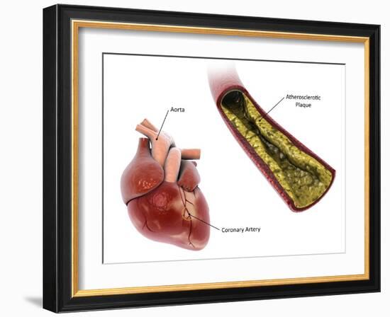 Atherosclerotic plaque in the artery, leading to a heart attack.-Stocktrek Images-Framed Art Print